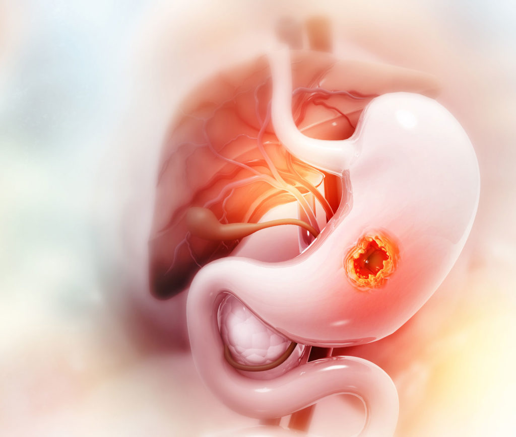 diete-speciale-gastrite