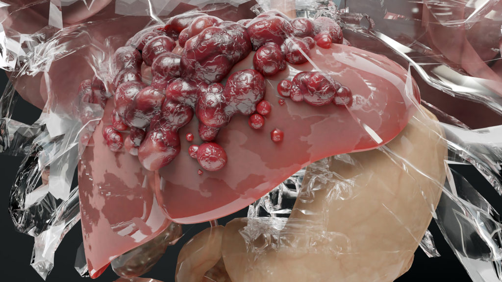 diete-speciale-hemochromatose