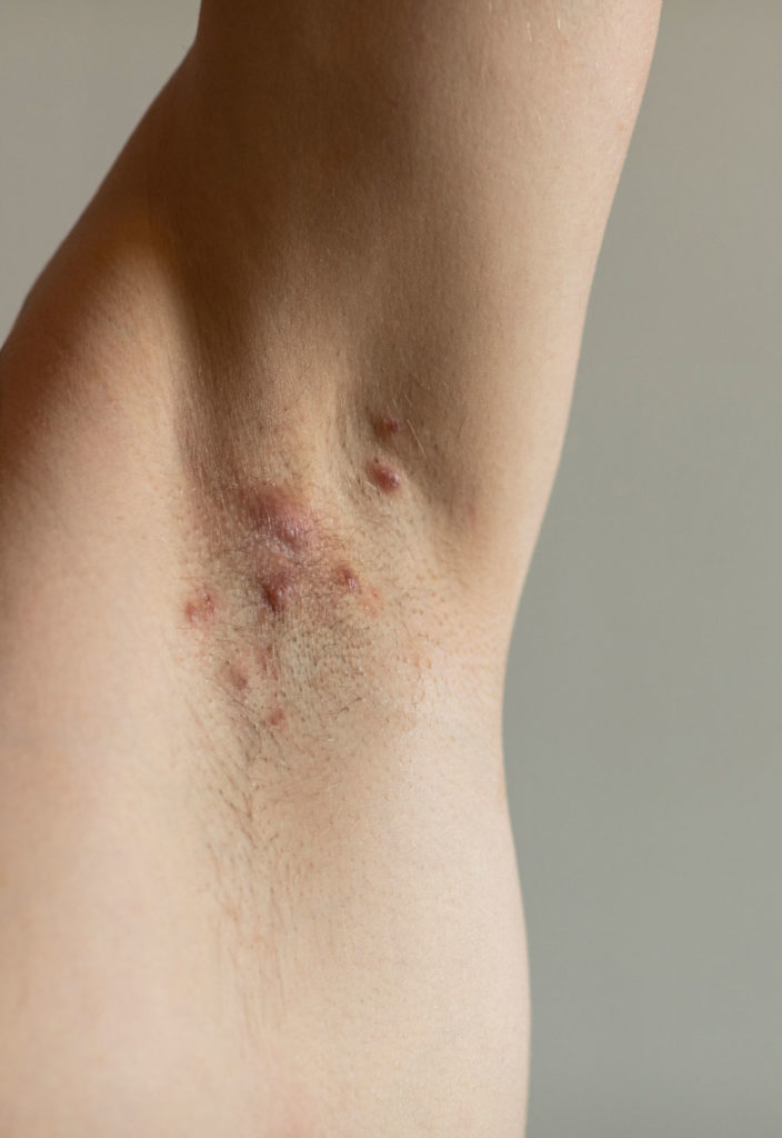 diete-speciale-maladie-de-verneuil