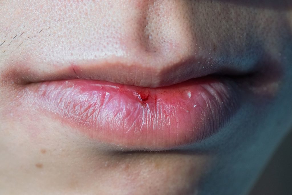 remede-bouche-seche-description